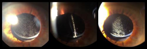 Artificial intraocular lens - glistening